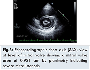 Severe Rheumatic Mitral Stenosis in Marfanoid Young Man Successfully